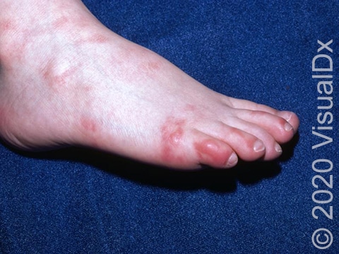 Bright red patches, some with blistering, on the foot and toes.