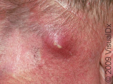Though an abscess is typically a deep infection, pus coming to the surface may be seen.