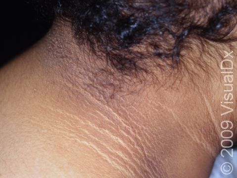 The thickening on the skin of the neck from acanthosis nigricans often has a 