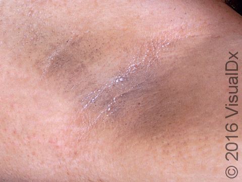 Acanthosis nigricans, most commonly, is noticed at the armpits and/or neck as a slightly thickened color change, which is sometimes described as appearing 