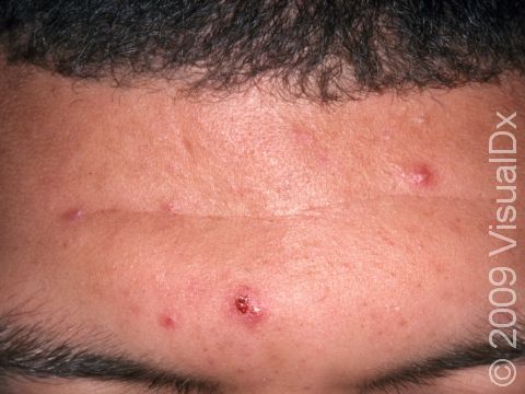 The bloody crust on the center acne lesion is a sign that it has been manipulated.