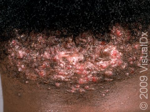 This image displays acne keloidalis that has been aggravated by rubbing and scratching.