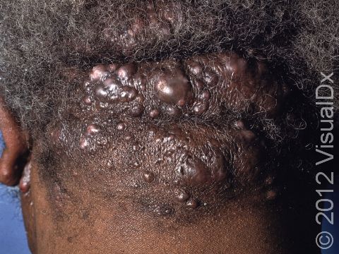 The back of the scalp and neck is the typical location for acne keloidalis.