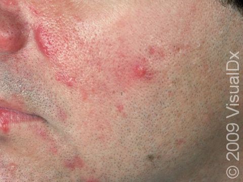 This image displays several large, inflamed bumps typical of acne vulgaris.