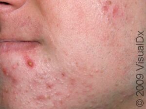 Acne (Acne Vulgaris) Condition, Treatments and Pictures for Adults ...