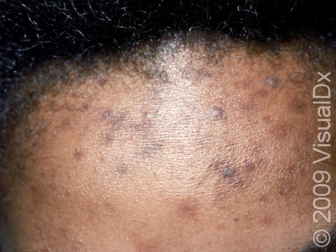 This image displays darker color (pigment) in areas that had acne previously, which takes longer to heal in people with darker skin.