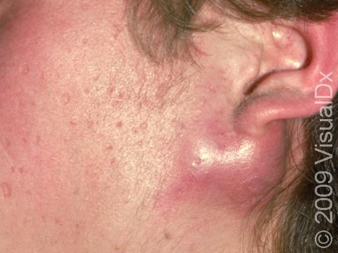 This image displays a large, inflamed acne cyst.