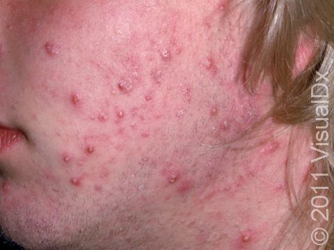 This image displays a mix of pus-filled and inflammatory acne.