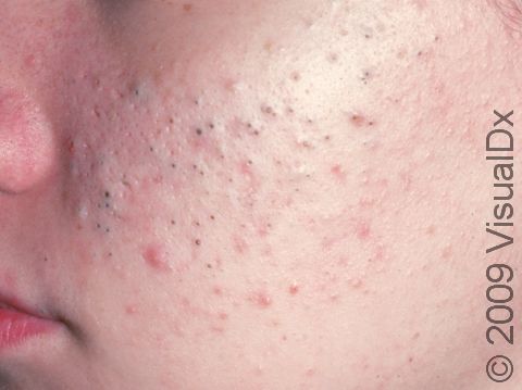 Blackheads (open comedones) are follicles plugged with scale and oil, as displayed in this image.