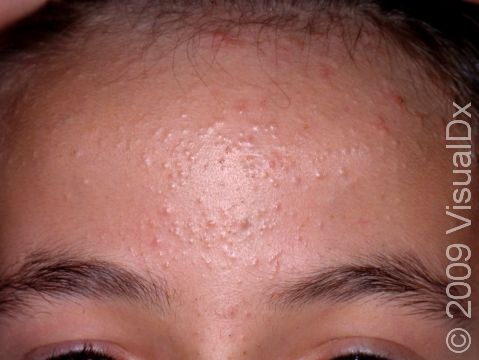 This image displays whiteheads and blackheads (open and closed comedones) on the forehead.