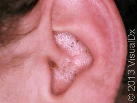 This image displays blackheads (open comedones) in the ear area typical of acne.