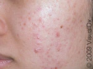 Acne (Acne Vulgaris) Condition, Treatments and Pictures for Adults ...