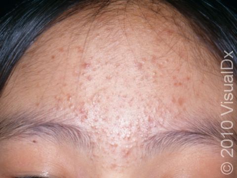 This image displays numerous whiteheads (closed comedones) and scattered acne bumps.