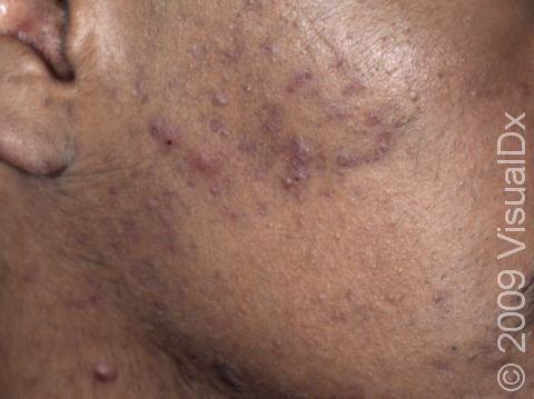 This image displays moderate inflammatory acne lesions.