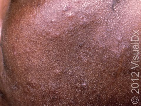 In people with darker skin, redness and inflammation of acne can be difficult to see.
