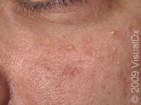 This image displays small, slightly elevated lesions and scars in an adult with chronic acne.