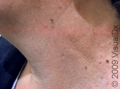 Skin tags are frequently found on the neck.