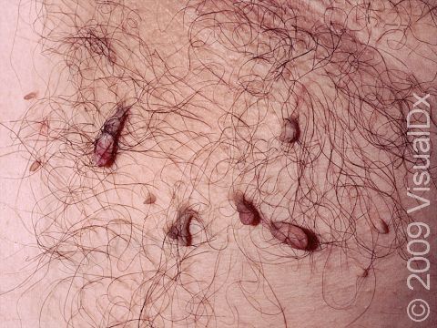 This image displays loosely hanging acrochordons (skin tags).