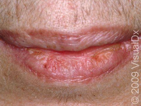 This image displays thick, scaly skin around the lips, typical of actinic cheilitis, due to sun damage.