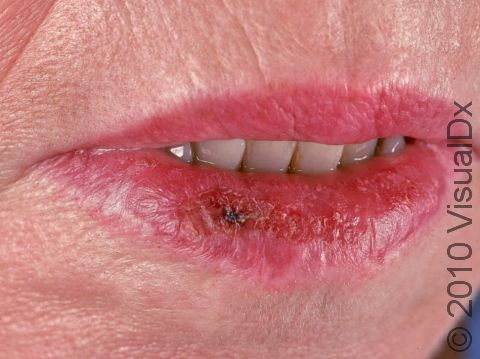 Lips affected by actinic cheilitis can appear scaly or crusty until treated.
