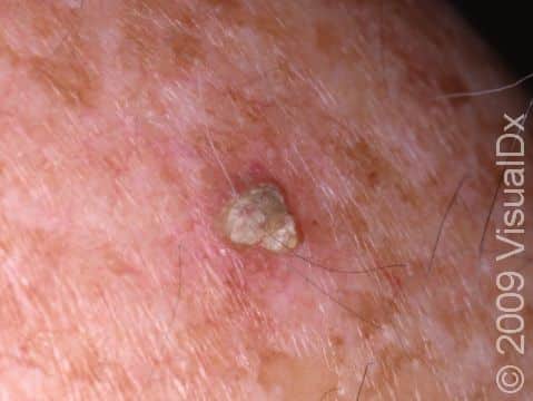 This image displays an actinic keratosis with brown spots suggesting chronic sun damage.
