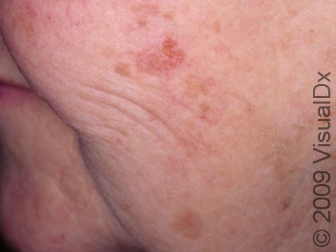 This image displays a rather large, inflamed actinic keratosis.