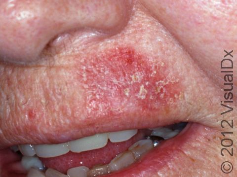 This image displays a very large, scaly actinic keratosis.