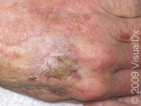 This image displays a large actinic keratosis with a yellowish crust.