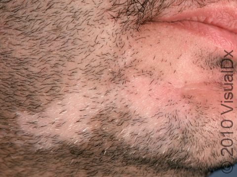 This image displays patches of hair loss in the beard area typical of alopecia areata as well as areas that were affected previously, with the hair regrowing in white (without pigment).