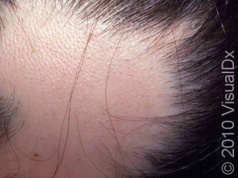This image displays a normal, healthy scalp with alopecia areata.