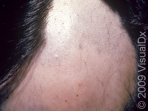 This image displays broken hairs in hair follicles with an otherwise smooth scalp caused by alopecia areata.