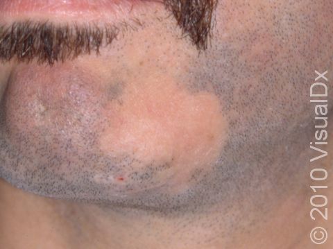 The beard area can be involved in alopecia areata, even when the scalp is not. Areas of hair loss are typically round and quite noticeable when the beard grows.