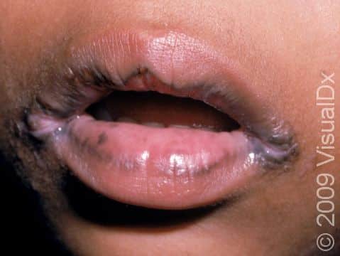 This image displays a frequent location for candida infection (angular cheilitis), the corners of the mouth.
