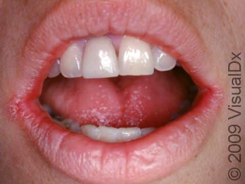 What Does A Lip Fungal Infection Look Like - Infoupdate.org