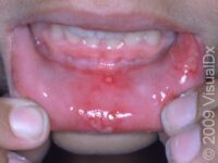 Canker Sore (Aphthous Ulcer)