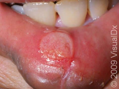 This image displays a large healing canker sore on the lower lip.