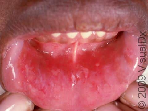 This image displays several small erosions and aphthous ulcers on the lower lip.