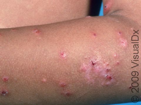 This image displays insect bites with bloody crusts due to severe itch and scratching.