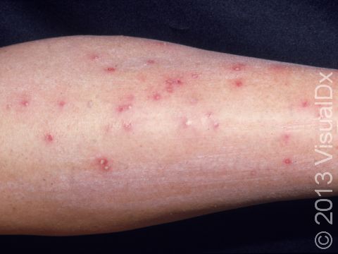 Insect bites in exposed skin areas may be numerous and leave flat, brown marks for weeks after the bites are healed.
