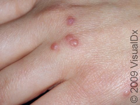 Insect bites are often multiple and may be grouped as on the hand in this individual. An older, flatter, partially healed bite is seen on the upper part of the hand.