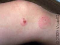 Bug Bite or Sting (Pediatric) – Child