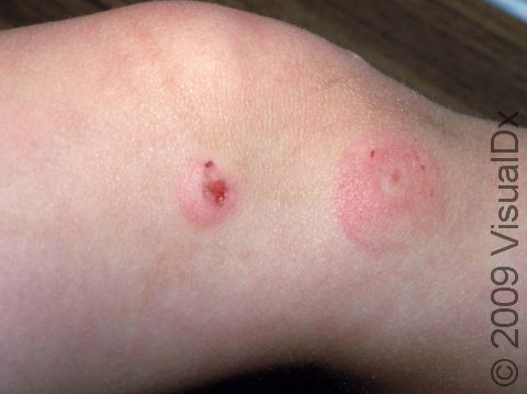 Insect bites or stings may be associated with large circular areas of swelling; the raw areas on the left lesion are probably due to scratching.