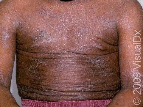 This image displays dry skin with prominent hair follicles and inflamed areas of skin typical of atopic dermatitis (eczema) on a person with darker skin.