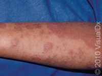 Eczema (Atopic Dermatitis) – Adult