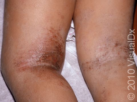 This image displays atopic dermatitis (eczema) in the body folds of the back of the legs coupled with staph bacteria.