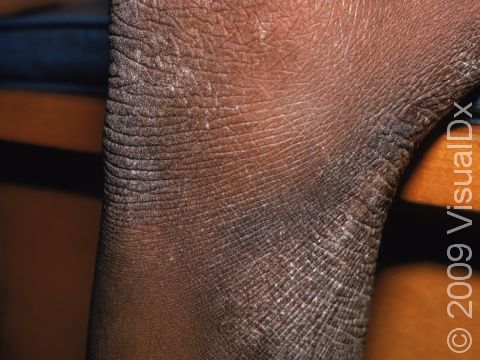 In atopic dermatitis (eczema), chronic itch and associated rubbing of the skin leads to skin thickening and the increased prominence of normal skin markings, as displayed in this image.