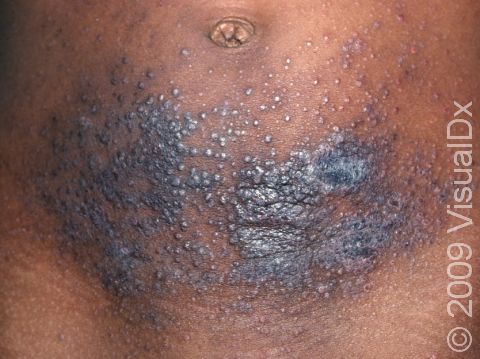 This image displays multiple small, dark brown bumps typical of atopic dermatitis (eczema) in a person with darker skin.