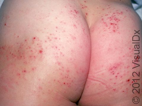 This image displays small, separate bumps with red lesions (due to scratching) from atopic dermatitis (eczema).