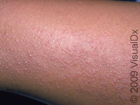 In atopic dermatitis (eczema), the rash often is seen as scaly bumps over each hair follicle.