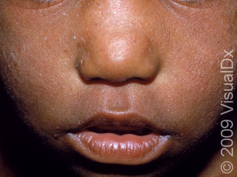 Children with atopic dermatitis (eczema) often have very dry skin and prominent skin folds just below the eyes.